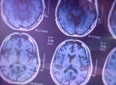 Brain scan
